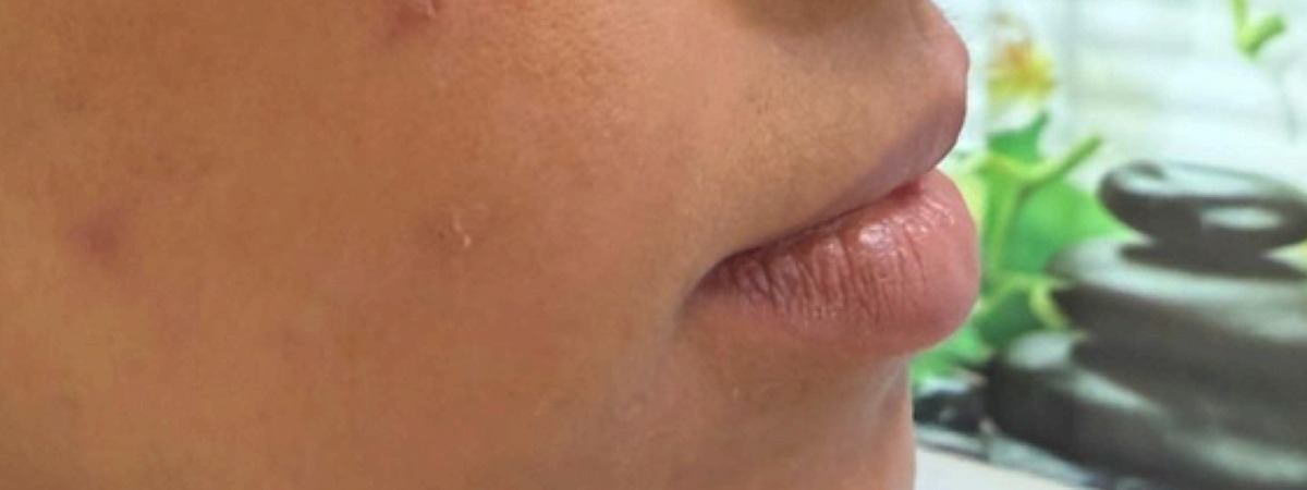 Antes do preenchimento labial